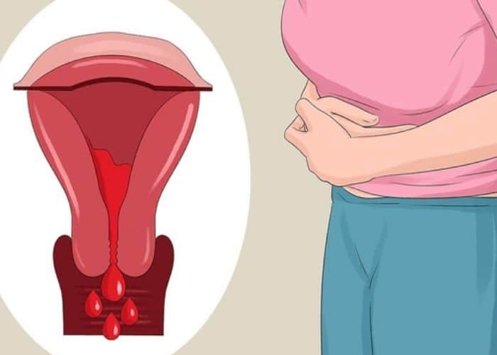 Lạc nội mạc tử cung - Nguyên nhân gây tiểu són ra máu