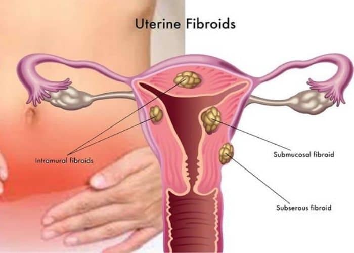 U xơ tử cung gây căng tức bụng dưới buồn đi tiểu ở nữ