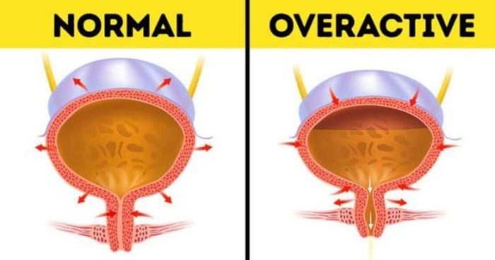 overactive bladder là gì?