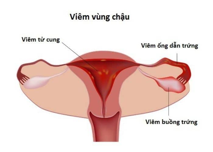 dau bung duoi phai do viem vung chau - Tìm hiểu ngay hiện tượng đi tiểu xong bị đau bụng dưới ở nữ