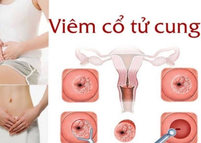 Đi tiểu ra máu tươi ở nữ giới do viêm cổ tử cung