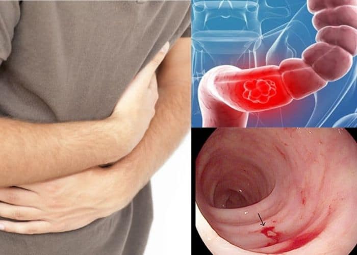 Viêm loét đại trực tràng gây đau bụng dưới đi tiểu buốt ở nam giới