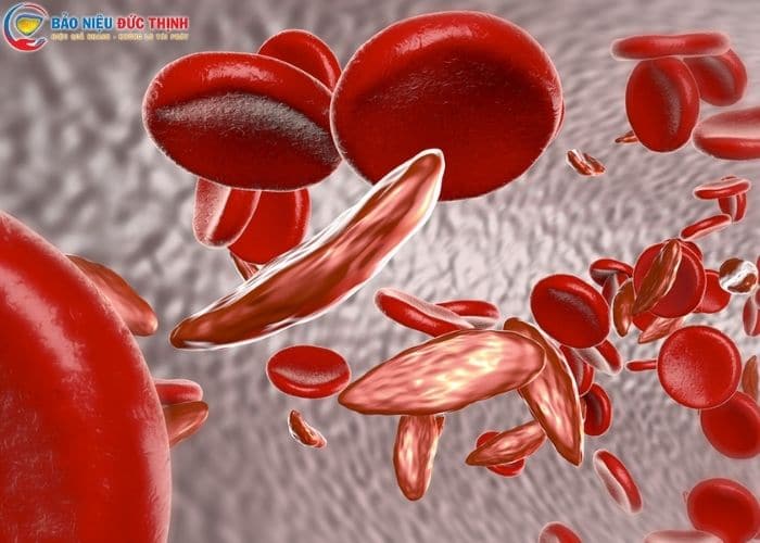 Bệnh lý về máu gây đi tiểu buốt ra máu đông