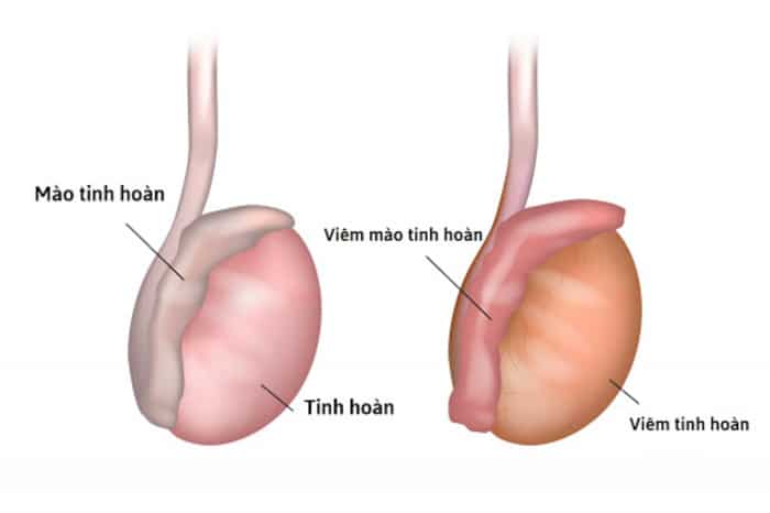 tieu kho dau bung 7 - Chia sẻ ngỡ ngàng từ bác sĩ chuyên khoa tiết niệu về chứng tiểu khó đau bụng