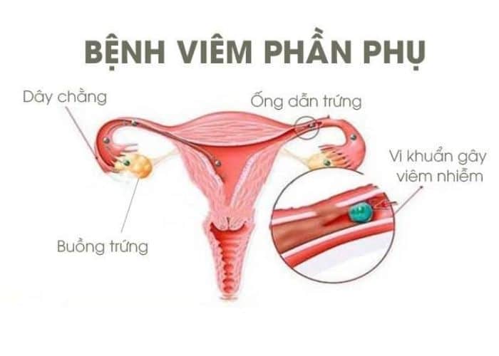 4.tieu buot ra mau dau bung duoi nu viem phan phu - [ CẢNH BÁO] Tiểu buốt ra máu đau bụng dưới ở nữ là bệnh gì?