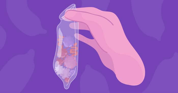 Đi tiểu ra chất nhầy ở nam và nữ có thể do nhiễm trùng lây qua đường tình dục