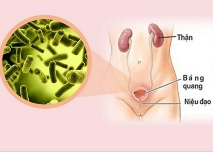 nguyen nhan dan den viem duog tiet nieu o nu - Nguyên nhân dẫn đến viêm đường tiết niệu ở nữ giới là gì?